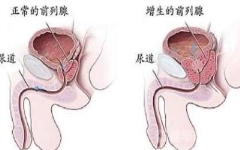 多过性生活前列腺肥大多缓解吗？三种行为易“犯事”